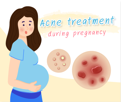 Acne treatment during pregnancy
